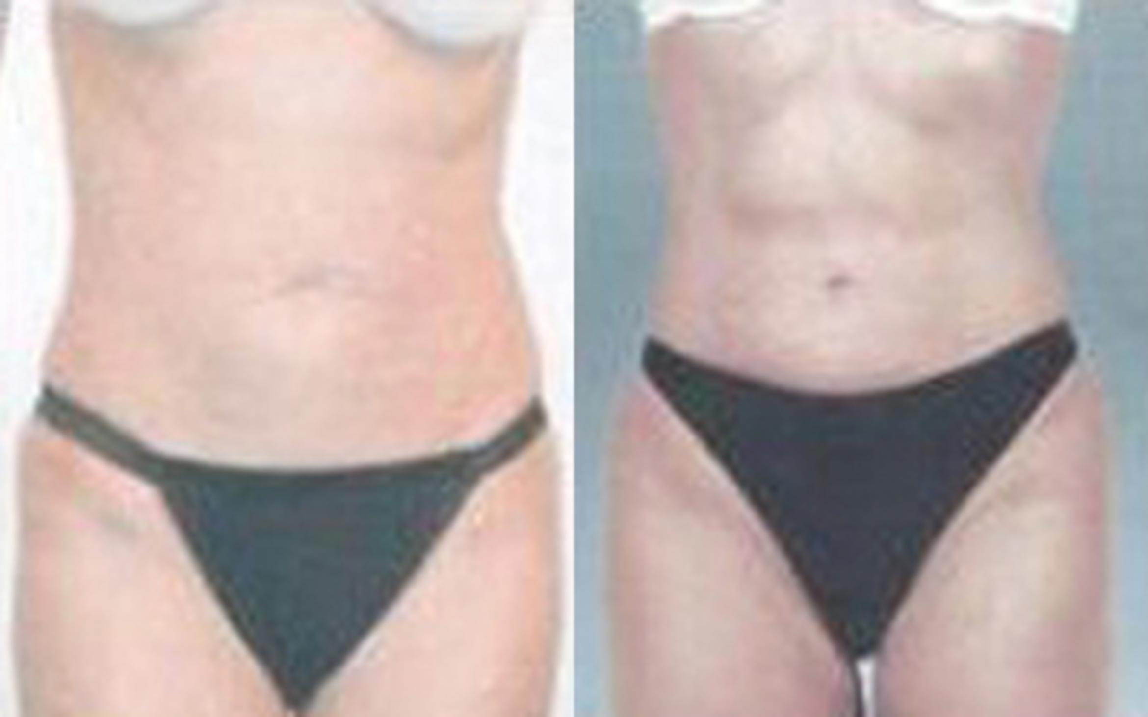 Before & After Abdominal Etching For Men Case 85 View 1 View in Houston, TX