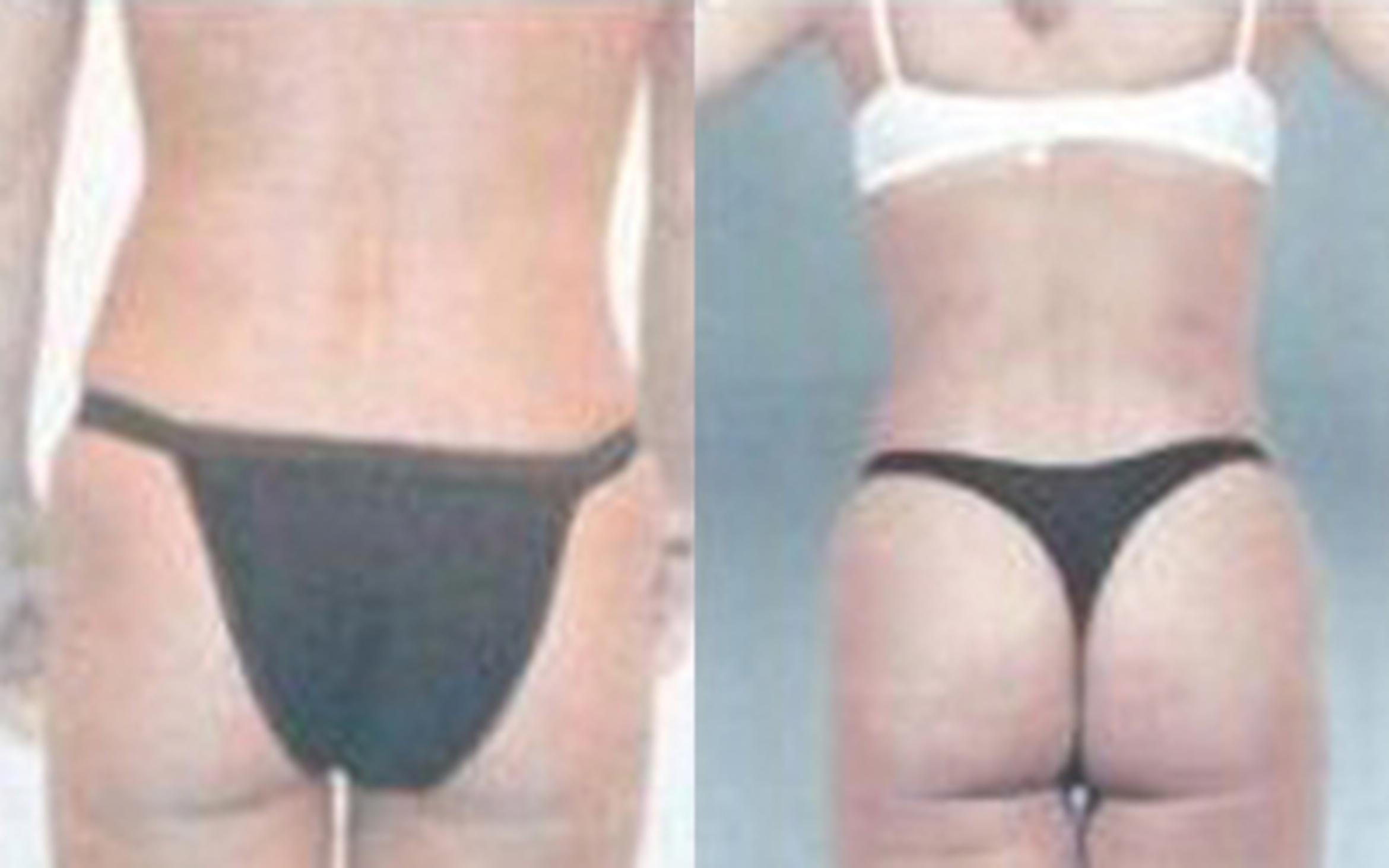 Before & After Abdominal Etching For Men Case 85 View 2 View in Houston, TX