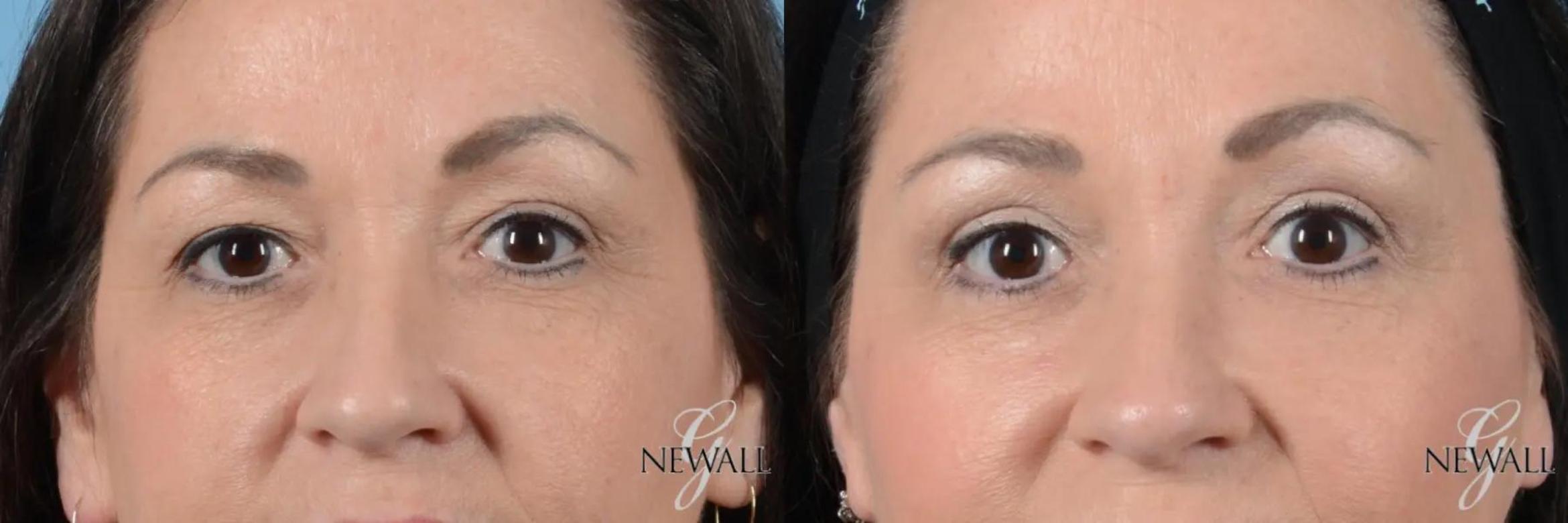 Before & After Blepharoplasty Case 17020 View 1 View in Houston, TX