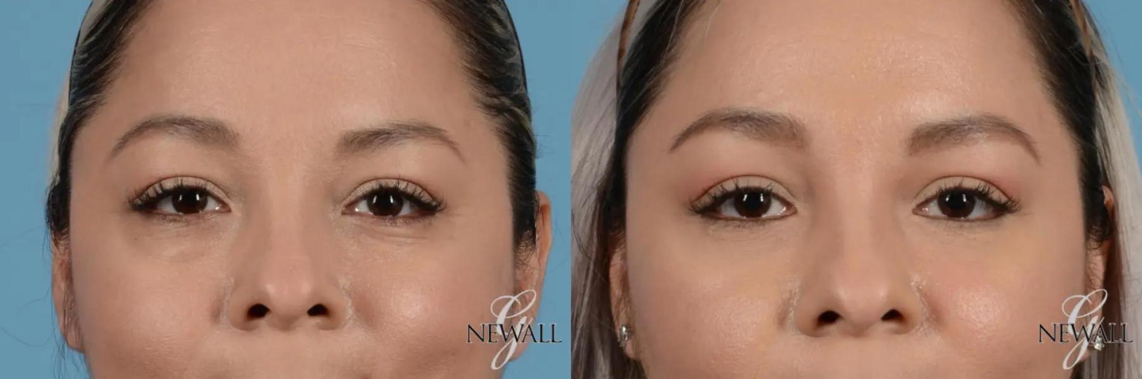Before & After Blepharoplasty Case 17453 View 1 View in Houston, TX