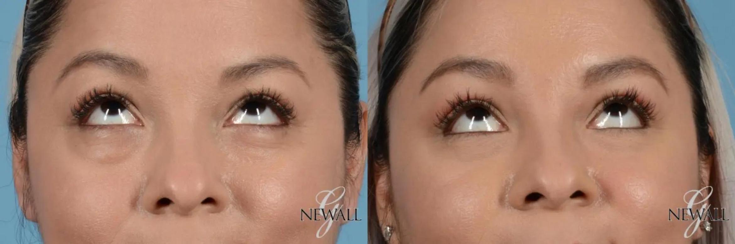 Before & After Blepharoplasty Case 17453 View 2 View in Houston, TX