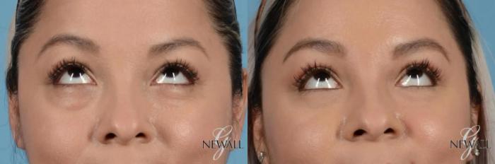 Before & After Blepharoplasty Case 17453 View 2 View in Houston, TX