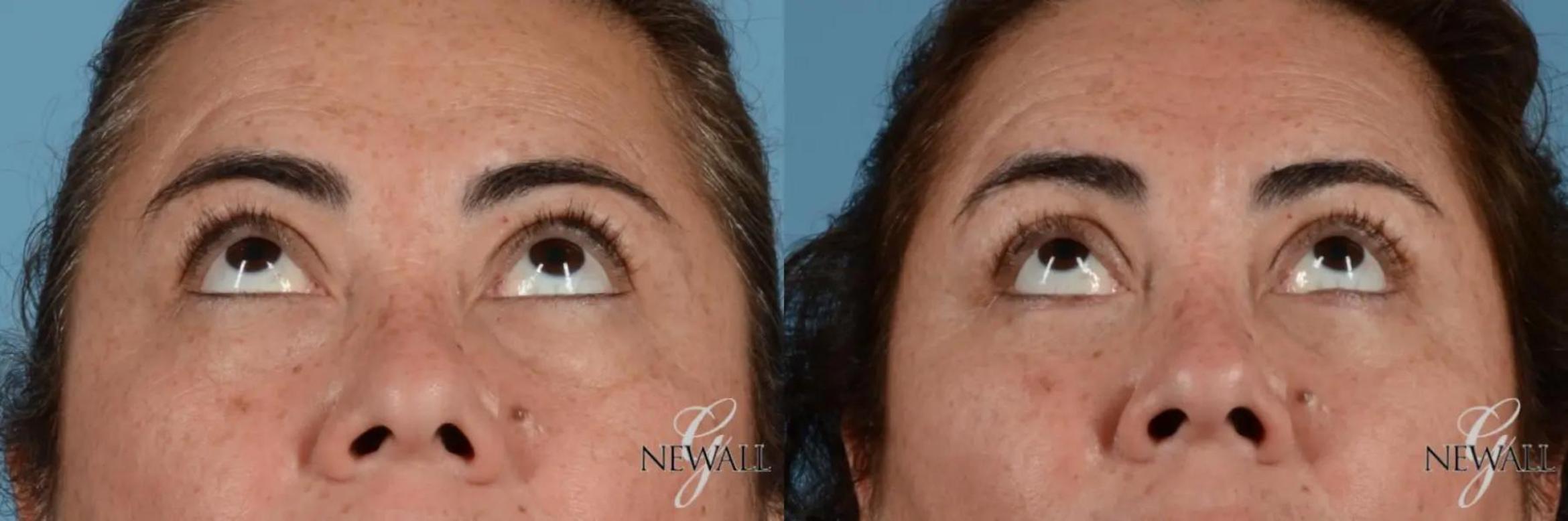 Before & After Blepharoplasty Case 17455 View 2 View in Houston, TX
