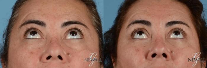 Before & After Blepharoplasty Case 17455 View 2 View in Houston, TX