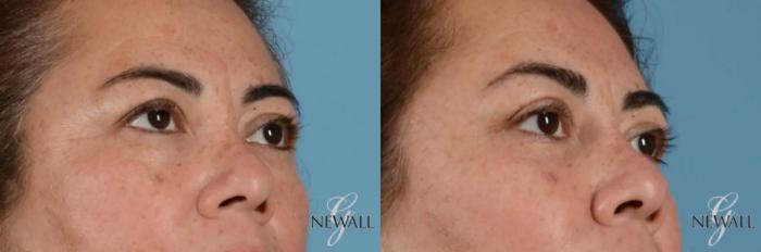 Before & After Blepharoplasty Case 17455 View 3 View in Houston, TX