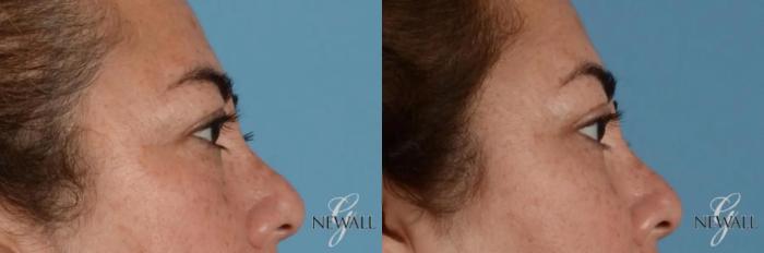 Before & After Blepharoplasty Case 17455 View 4 View in Houston, TX