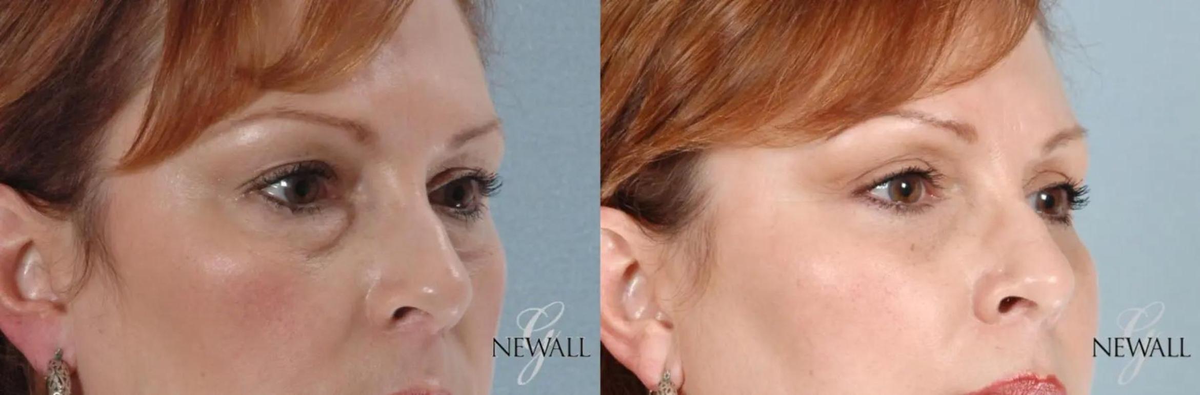 Before & After Blepharoplasty Case 17456 View 2 View in Houston, TX