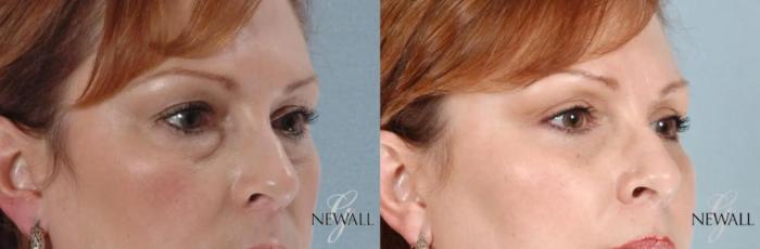 Before & After Blepharoplasty Case 17456 View 2 View in Houston, TX
