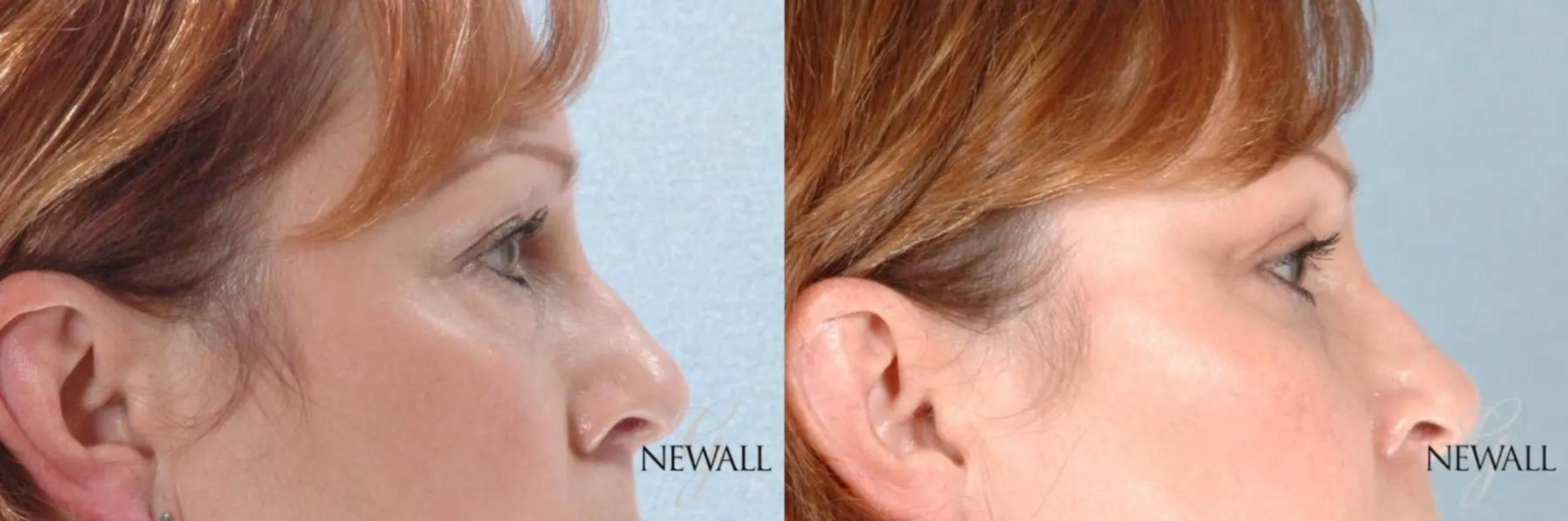 Before & After Blepharoplasty Case 17456 View 3 View in Houston, TX