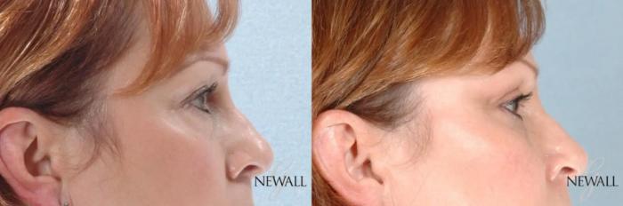 Before & After Blepharoplasty Case 17456 View 3 View in Houston, TX