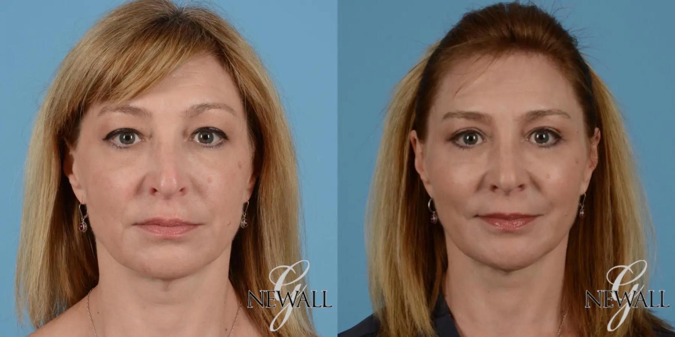 Before & After Blepharoplasty Case 17547 View 1 View in Houston, TX