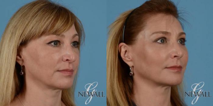 Before & After Blepharoplasty Case 17547 View 2 View in Houston, TX