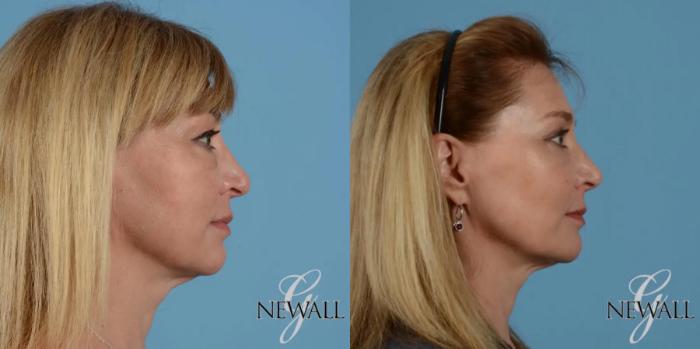Before & After Blepharoplasty Case 17547 View 3 View in Houston, TX