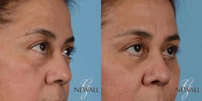 Before & After Blepharoplasty Case 17563 View 2 View in Houston, TX