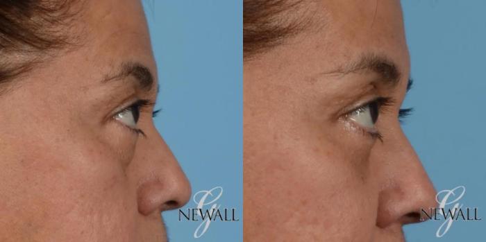 Before & After Blepharoplasty Case 17563 View 3 View in Houston, TX