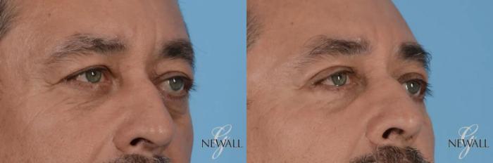 Before & After Blepharoplasty For Men Case 17025 View 2 View in Houston, TX