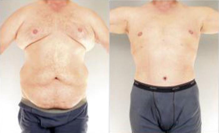Before & After Body Lift Case 5509 View 1 View in Houston, TX