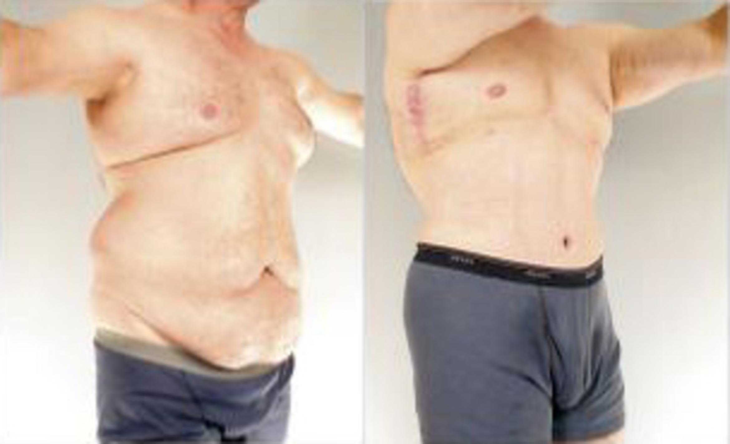 Before & After Body Lift Case 5509 View 2 View in Houston, TX