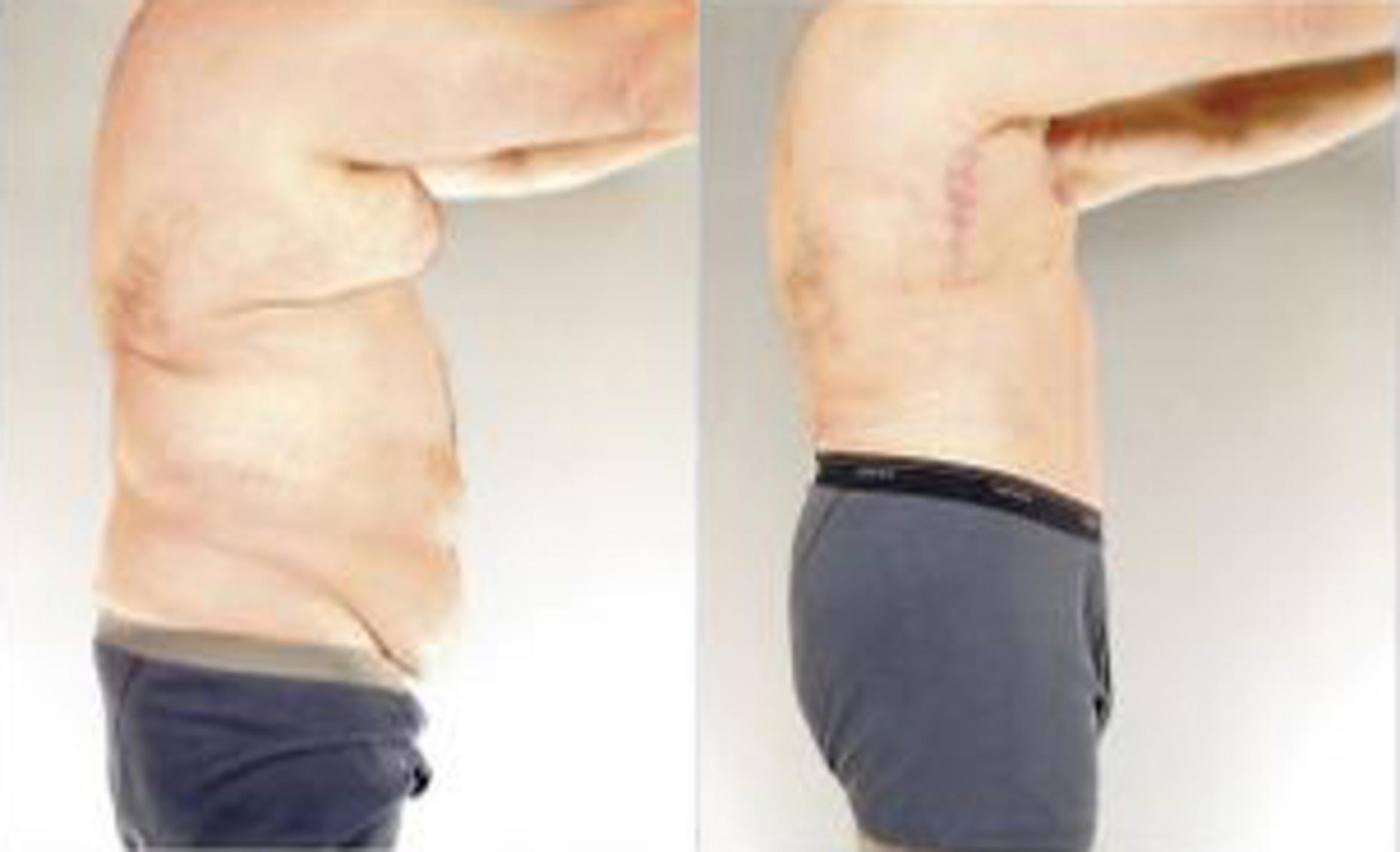 Before & After Body Lift Case 5509 View 3 View in Houston, TX