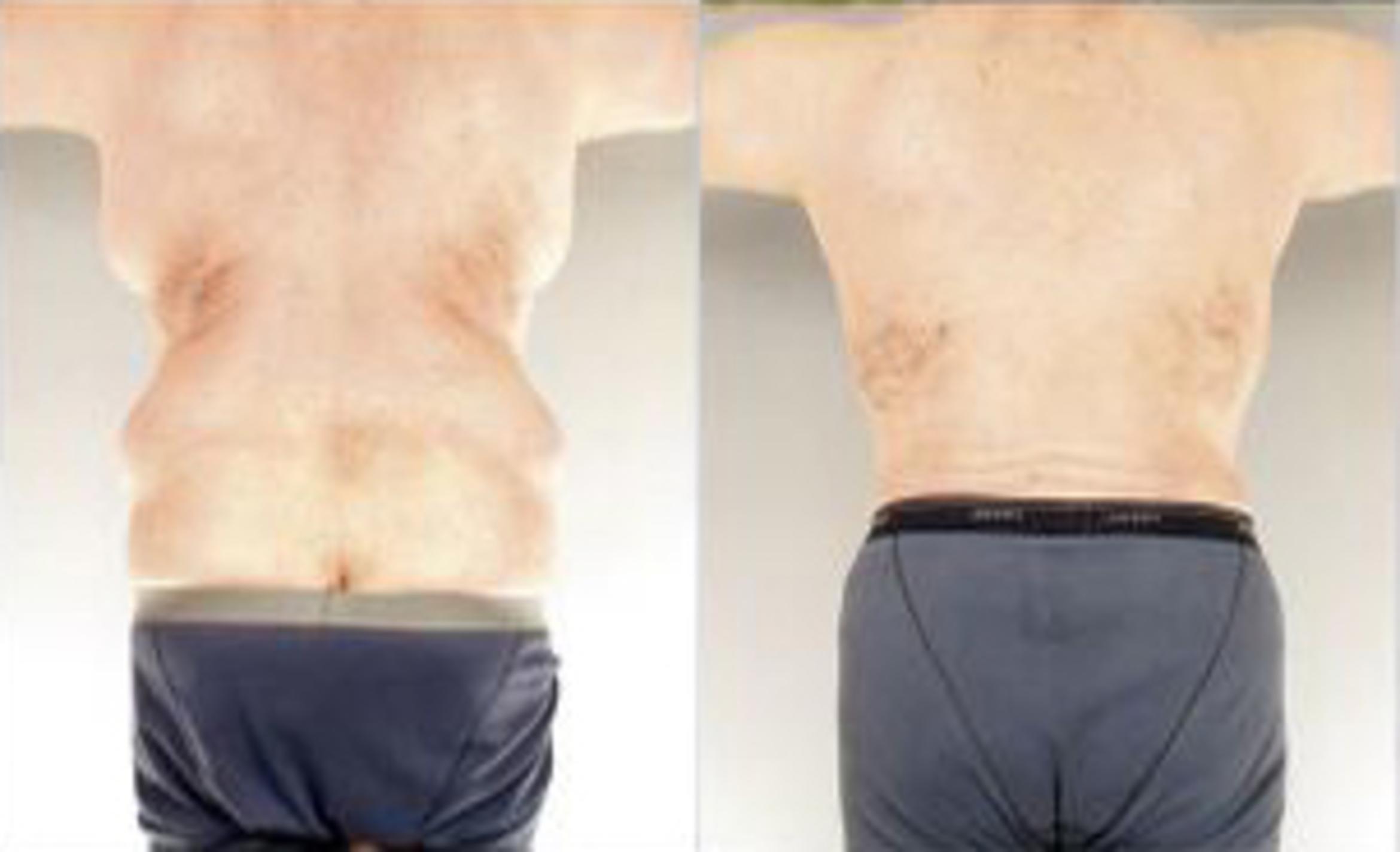 Before & After Body Lift Case 5509 View 4 View in Houston, TX