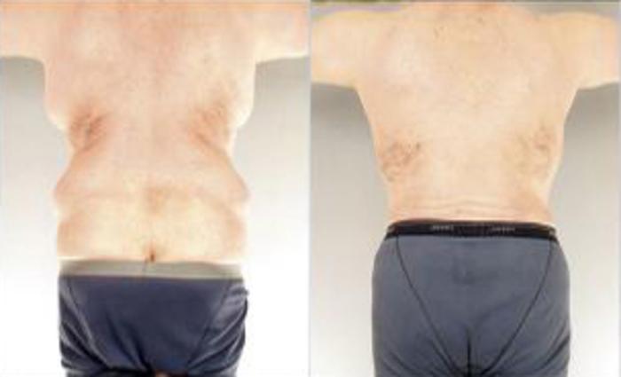 Before & After Body Lift Case 5509 View 4 View in Houston, TX