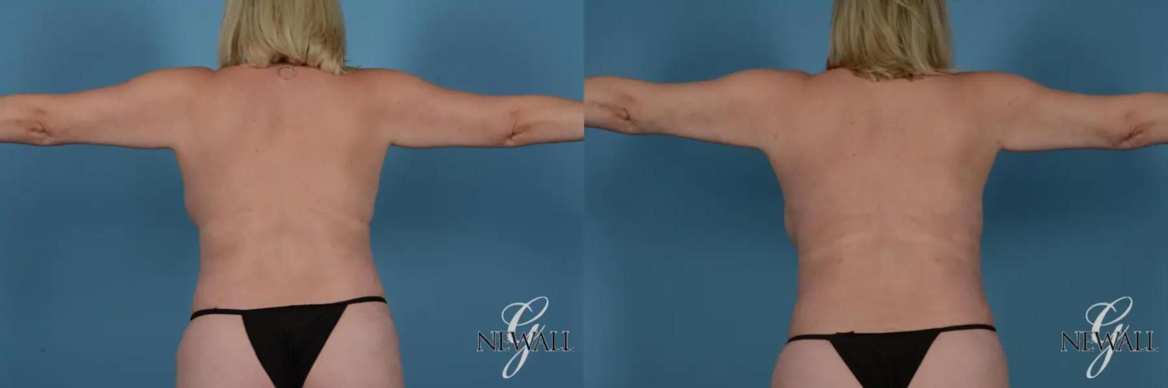 Before & After BodyTite Case 17411 View 1 View in Houston, TX