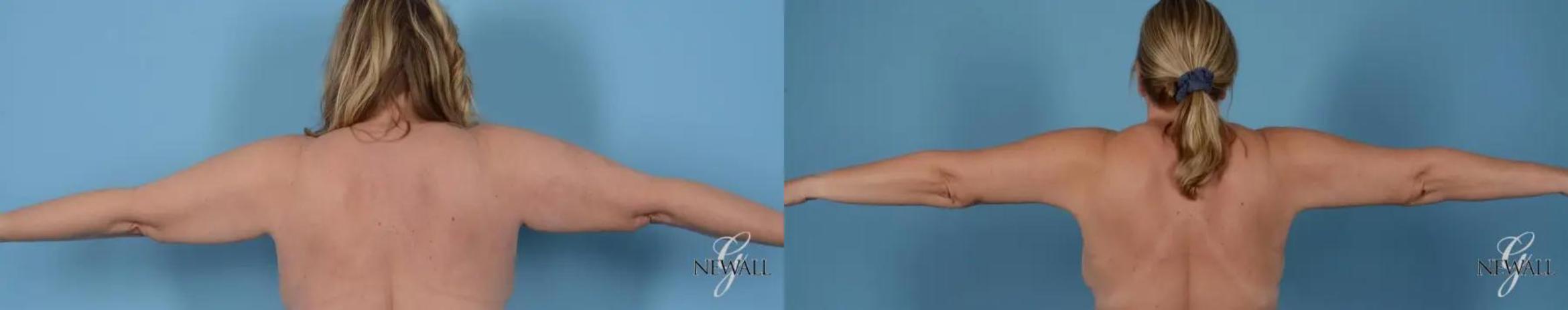 Before & After Brachioplasty Case 17001 View 1 View in Houston, TX