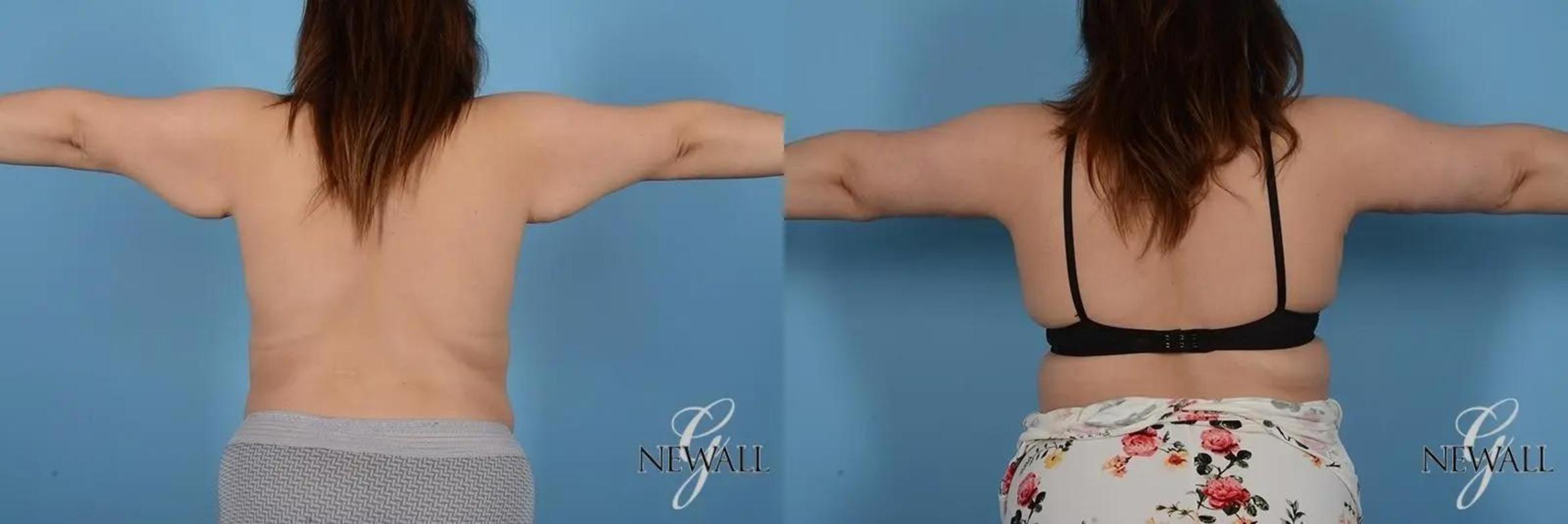 Before & After Brachioplasty Case 17002 View 1 View in Houston, TX