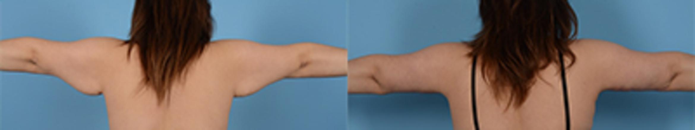Before & After Brachioplasty Case 24865 View 1 View in Houston, TX