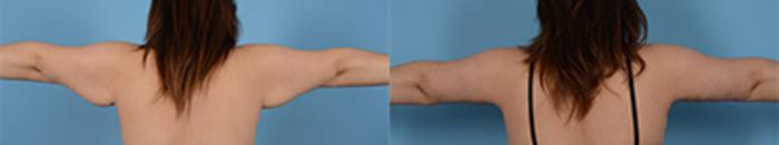 Before & After Brachioplasty Case 24865 View 1 View in Houston, TX