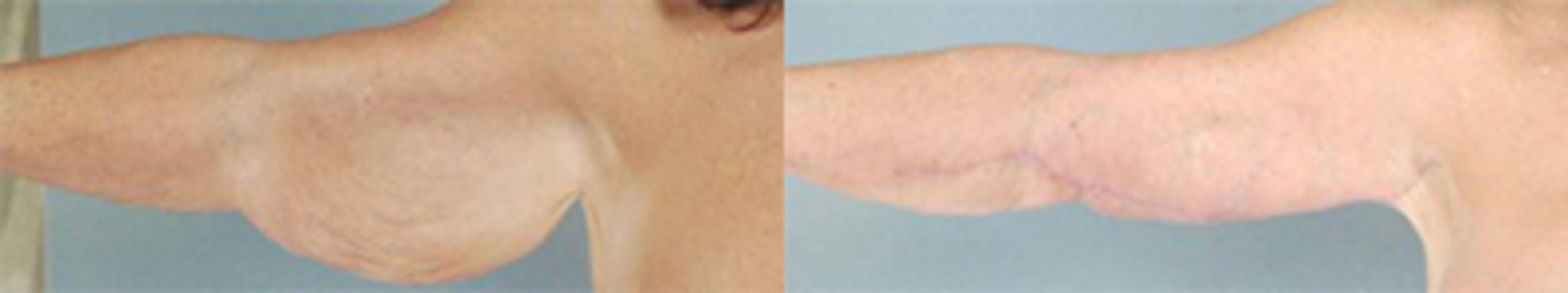 Before & After Brachioplasty Case 3030 View 1 View in Houston, TX