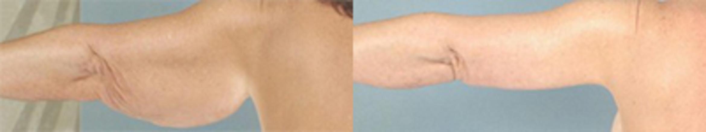 Before & After Brachioplasty Case 3030 View 2 View in Houston, TX