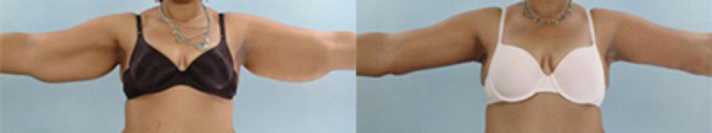 Before & After Brachioplasty Case 3036 View 1 View in Houston, TX