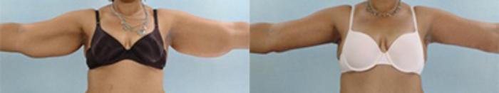 Before & After Brachioplasty Case 3036 View 1 View in Houston, TX