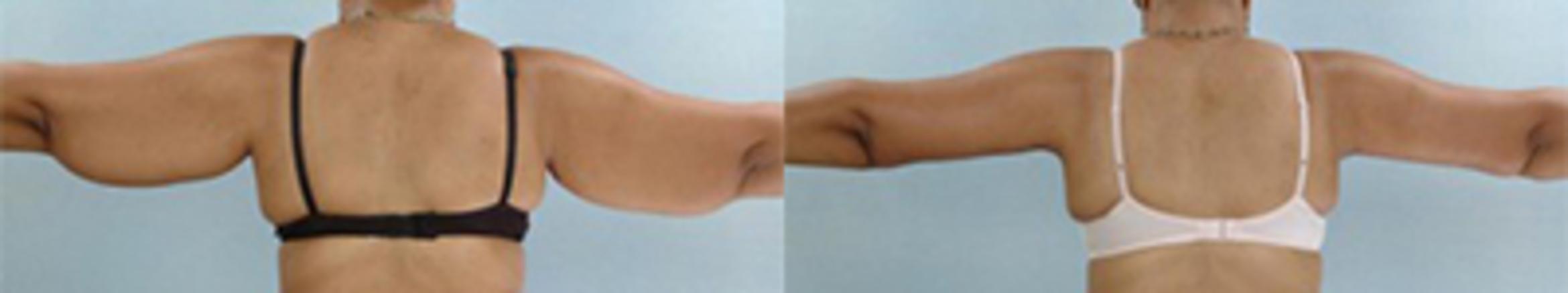 Before & After Brachioplasty Case 3036 View 2 View in Houston, TX