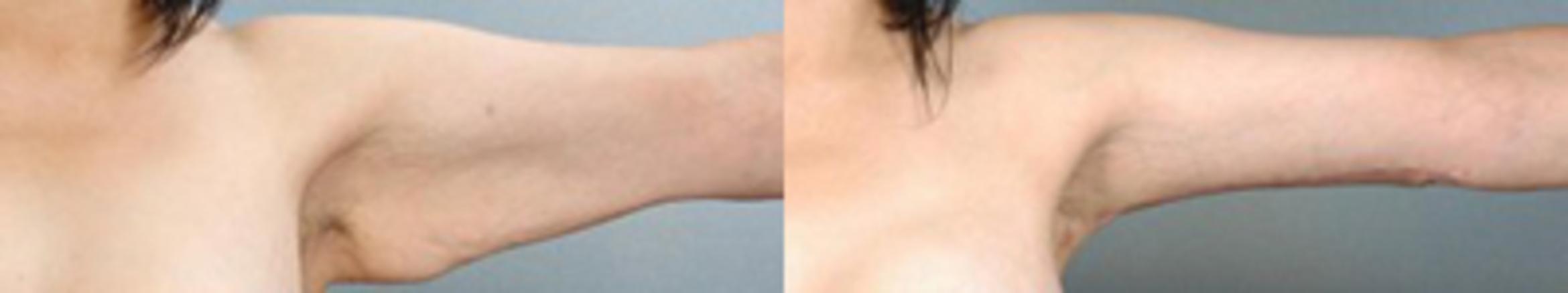 Before & After Brachioplasty Case 3042 View 1 View in Houston, TX