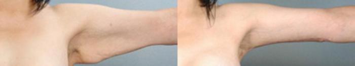 Before & After Brachioplasty Case 3042 View 1 View in Houston, TX
