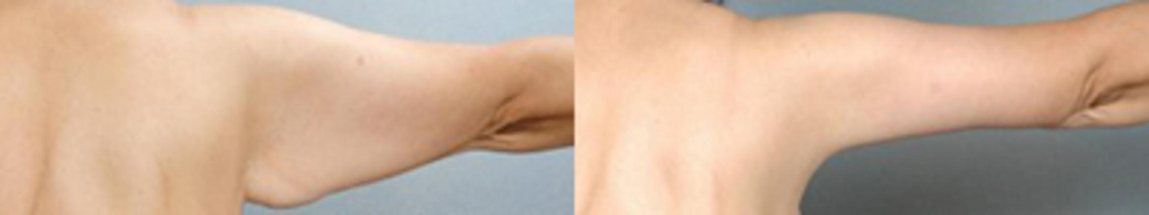 Before & After Brachioplasty Case 3042 View 2 View in Houston, TX