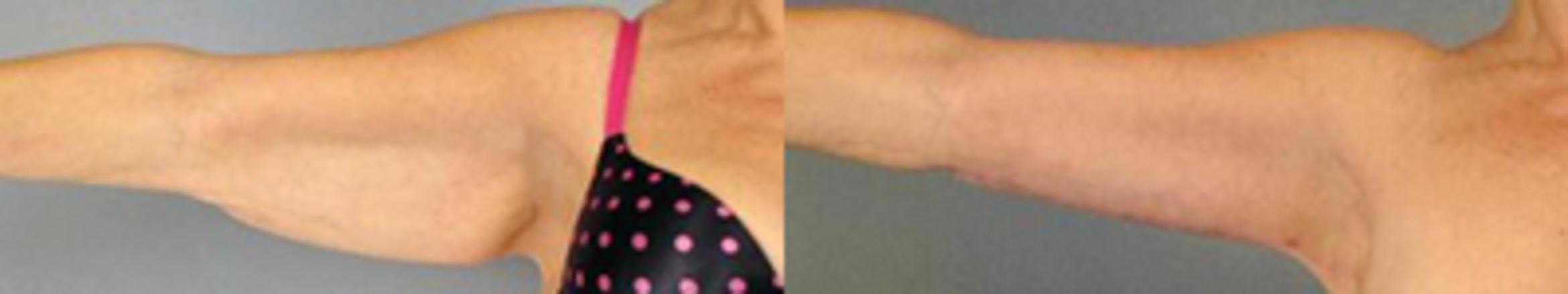 Before & After Brachioplasty Case 3048 View 1 View in Houston, TX