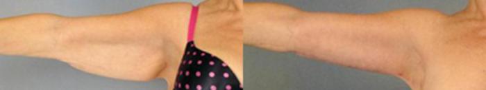 Before & After Brachioplasty Case 3048 View 1 View in Houston, TX