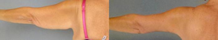 Before & After Brachioplasty Case 3048 View 2 View in Houston, TX