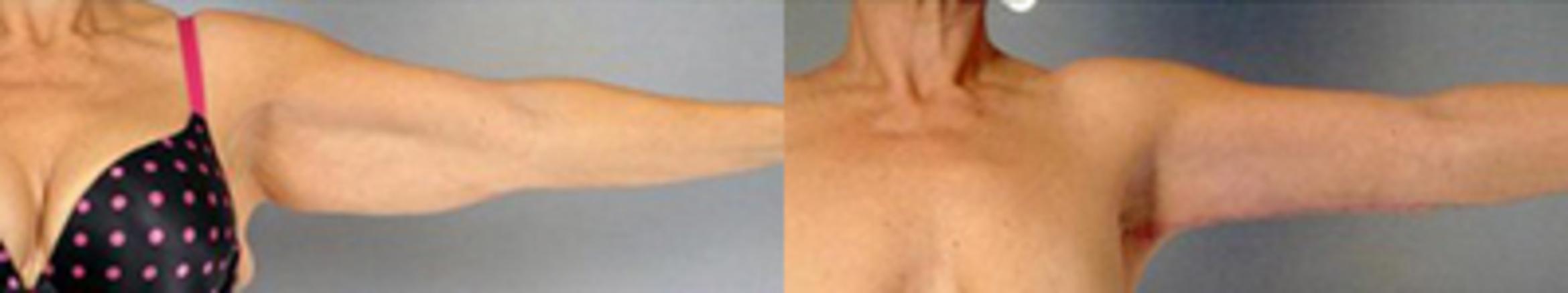 Before & After Brachioplasty Case 3048 View 3 View in Houston, TX