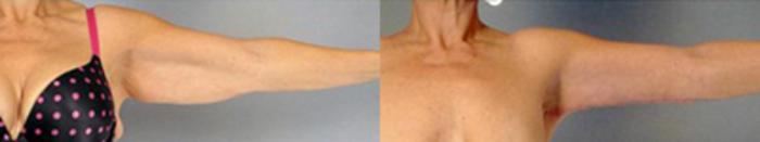 Before & After Brachioplasty Case 3048 View 3 View in Houston, TX