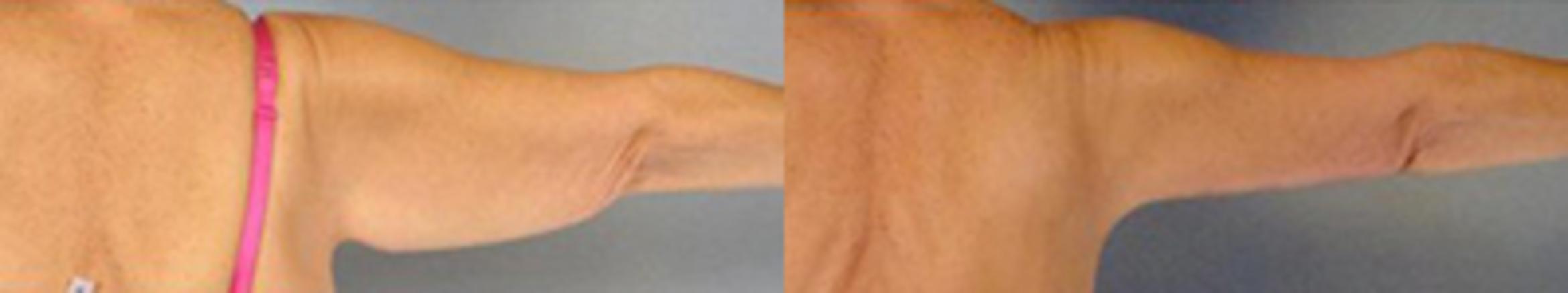 Before & After Brachioplasty Case 3048 View 4 View in Houston, TX