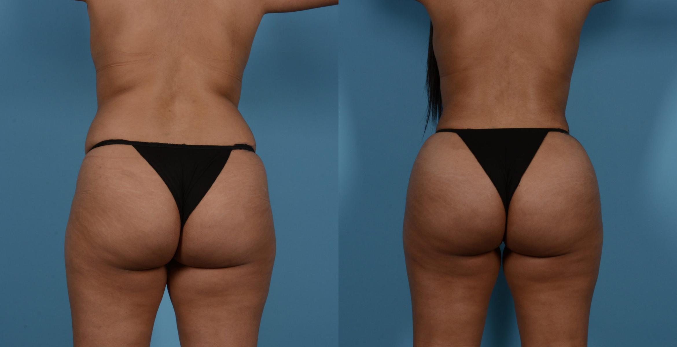 Before & After Brazilian Butt Lift Case 130866 View 1 View in Houston, TX