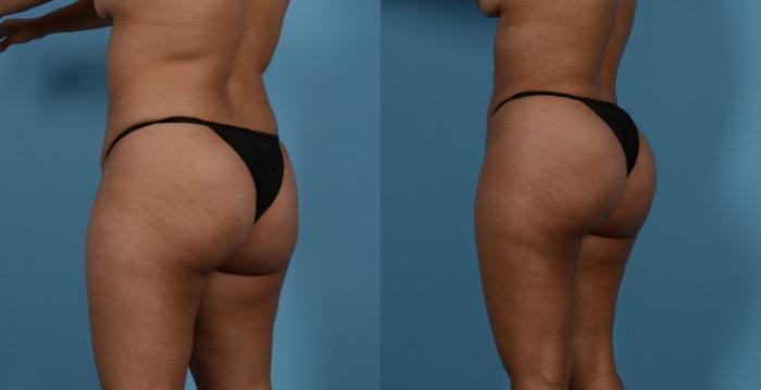 Before & After Brazilian Butt Lift Case 130866 View 2 View in Houston, TX