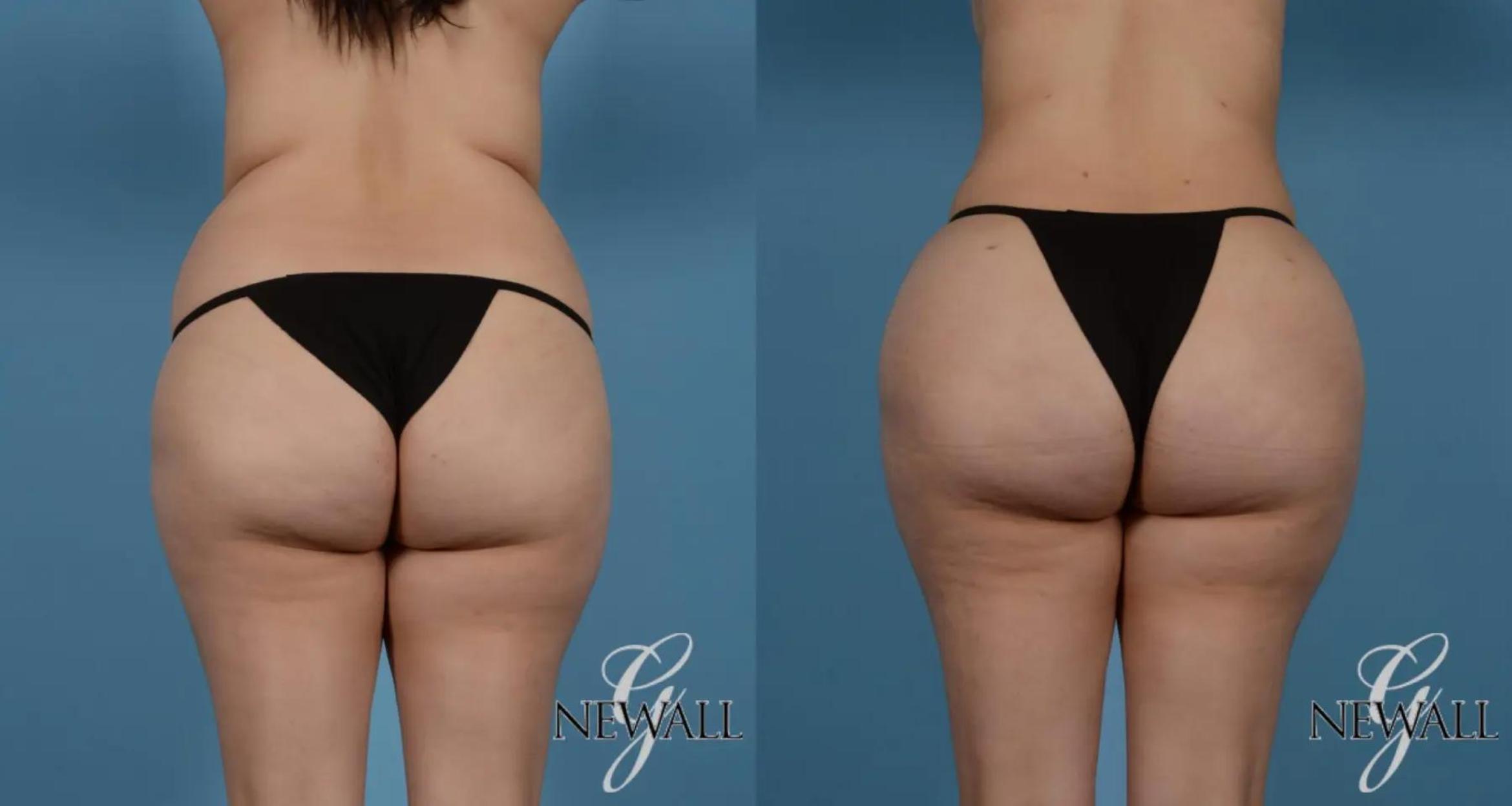 Before & After Brazilian Butt Lift Case 16980 View 1 View in Houston, TX