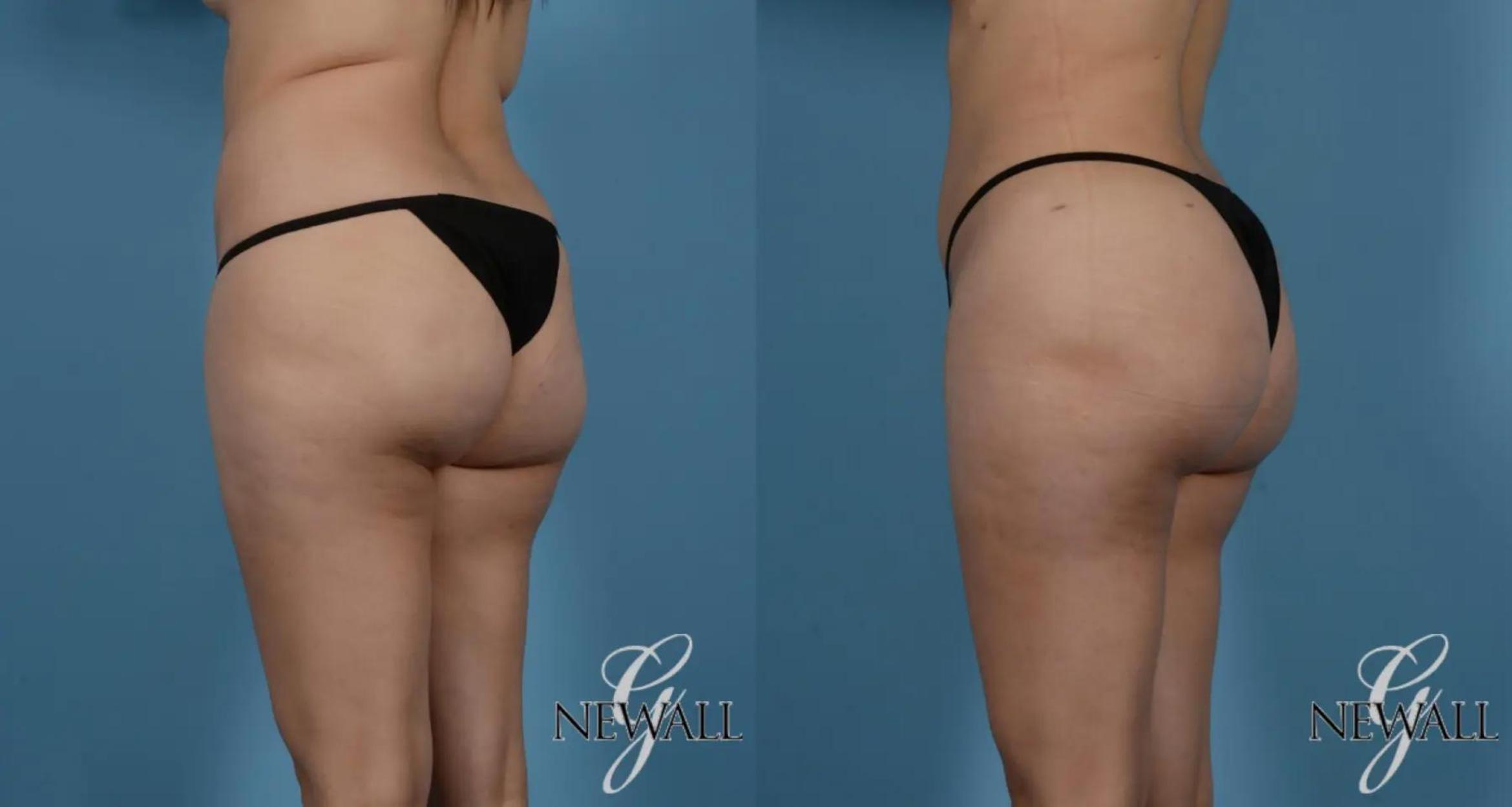 Before & After Brazilian Butt Lift Case 16980 View 2 View in Houston, TX