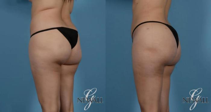 Before & After Brazilian Butt Lift Case 16980 View 2 View in Houston, TX
