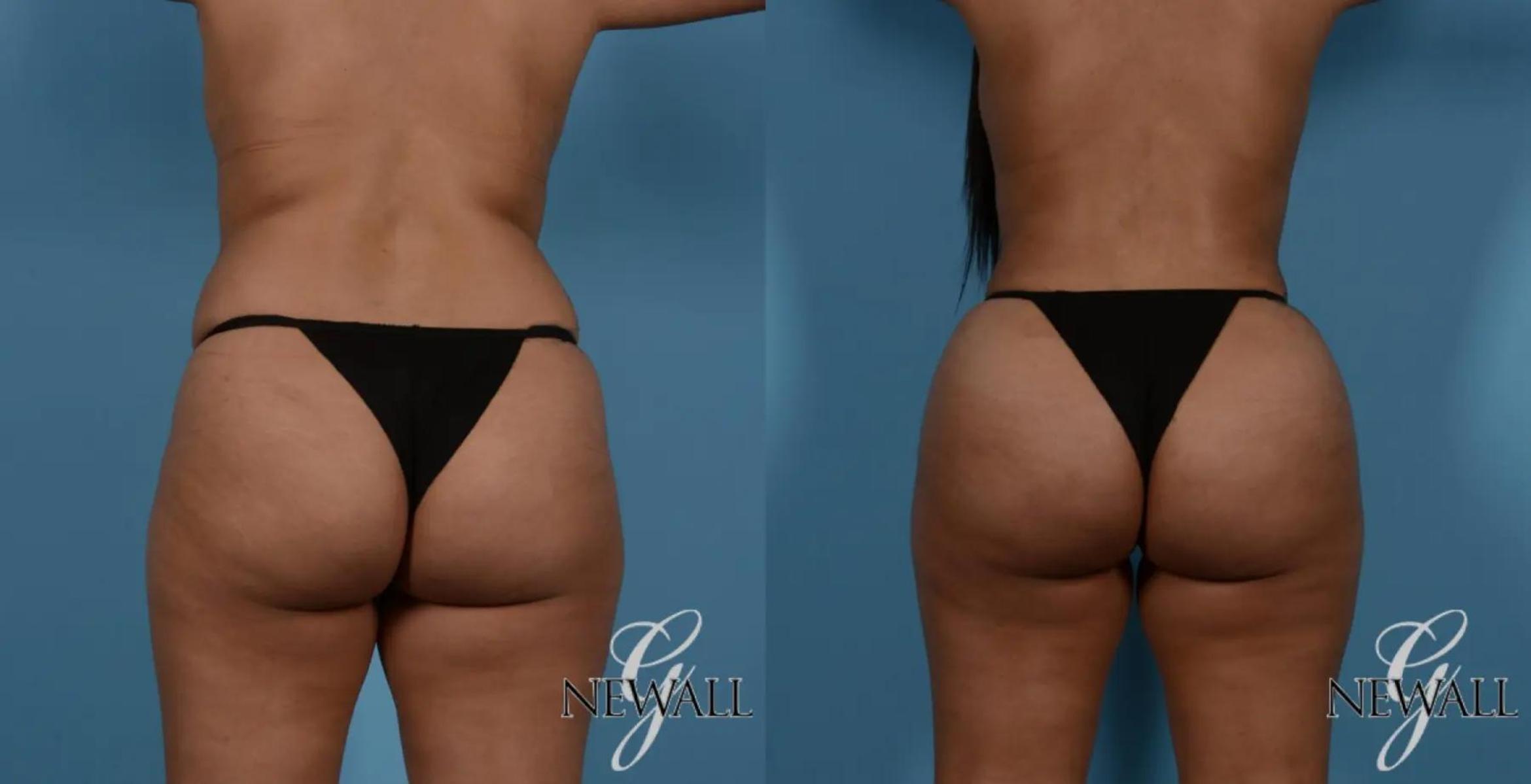 Before & After Brazilian Butt Lift Case 16982 View 1 View in Houston, TX